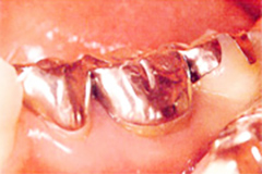銀歯の欠点
