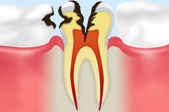 ひどい虫歯でも抜歯を避ける方法～根管治療
