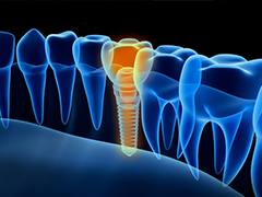 インプラント治療とは